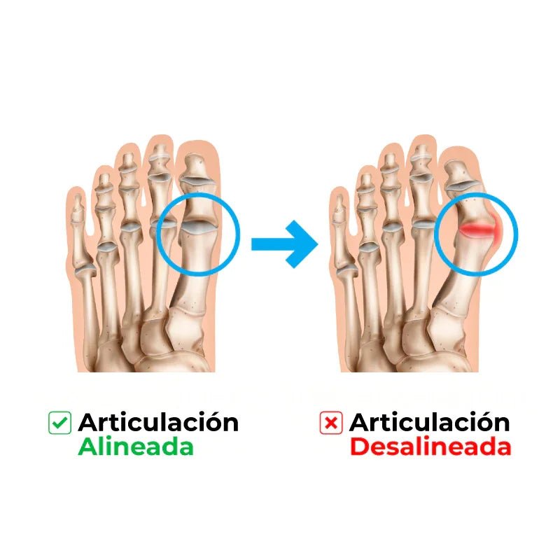AliviFlex™️ – Acelera la alineación de tus juanetes mientras duermes